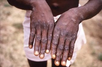 Sudan: Trường hợp đầu tiên mắc bệnh đậu mùa khỉ là học sinh