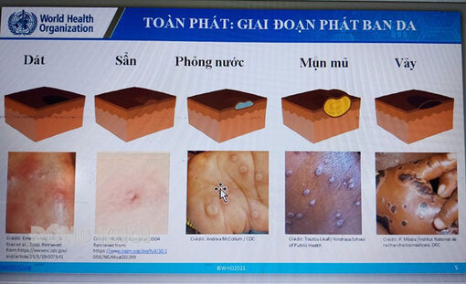 Bến Tre: Chủ động điều kiện ứng phó bệnh đậu mùa khỉ