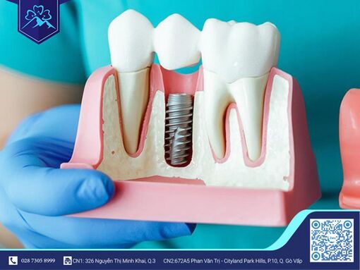 Dịch vụ trồng răng Implant tại Nha khoa Flora