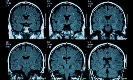 Não của thanh thiếu niên có dấu hiệu lão hóa nhanh hơn sau đại dịch COVID-19