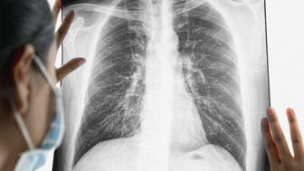 Ngày càng nhiều người dưới 40 tuổi mắc ung thư phổi