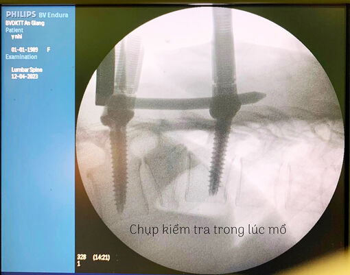 Bệnh viện Đa khoa Trung tâm An Giang triển khai kỹ thuật phẫu thuật cột sống xâm lấn tối thiểu (MISS)