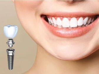 Trồng răng Implant nguyên hàm - Giải pháp cải thiện hiệu quả tình trạng mất răng