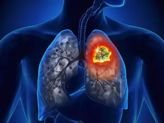 Ung thư phổi đang 'rình rập' bạn nếu thức dậy buổi sáng thấy có dấu hiệu này