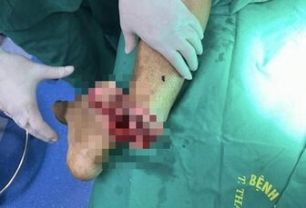 Bác sĩ xuyên đêm nối bàn chân người đàn ông bị cưa máy cắt đứt lìa