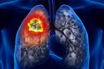 Phát hiện ung thư phổi di căn từ triệu chứng đau lưng