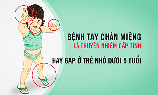 Các biện pháp phòng bệnh tay - chân - miệng