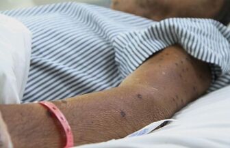 Cứu sống một bệnh nhân bị ong vò vẽ đốt hơn 120 vết ở Bạc Liêu