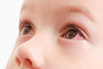 Đau mắt đỏ biến chứng có thể ảnh hưởng tới thị lực lâu dài của trẻ