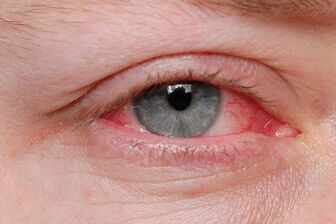 Hơn 71.000 ca đau mắt đỏ trong 8 tháng, TP.HCM truy tìm tác nhân gây bệnh