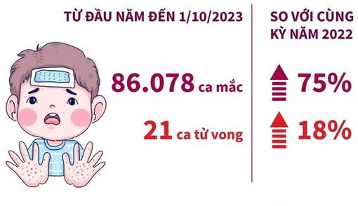 Số ca mắc bệnh tay chân miệng tăng tới 75% so với năm trước