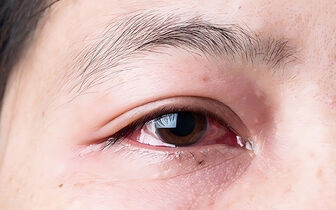 Tác nhân gây đau mắt đỏ và diễn biến của bệnh