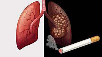 Thuốc lá - tác nhân gây bệnh hàng đầu ở phổi