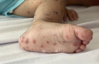 Số ca mắc các loại bệnh truyền nhiễm tại Đắk Nông tăng mạnh