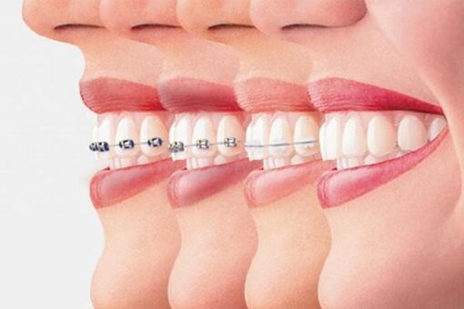 Phương pháp nào giúp niềng răng hô đạt hiệu quả cao?