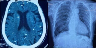 Nang sán dây lợn gây vôi hóa đầy cơ thể