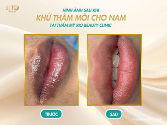 Không cần son vẫn có đôi môi hồng tự nhiên nhờ khử thâm môi