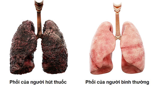 Thuốc lá và các bệnh về hô hấp Thuốc lá và các bệnh về hô hấp