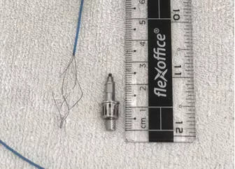 Sau trồng răng implant, bất ngờ phát hiện dị vật mắc trong phế quản