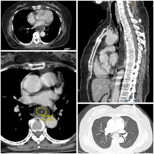 U mỡ thực quản “kích thước khủng” dưới niêm mạc khiến người bệnh nuốt nghẹn kéo dài