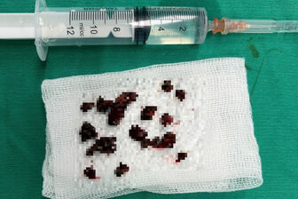 Người đàn ông Phú Thọ nhiễm loại nấm đen nguy hiểm ăn mòn xương