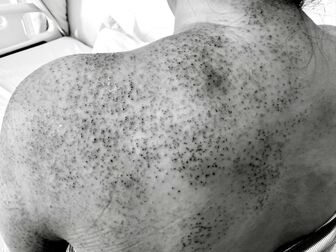 Nhập viện do trị nhức mỏi bằng chích lể, giác hơi