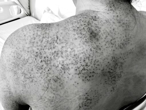 Nhập viện do trị nhức mỏi bằng chích lể, giác hơi