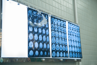 Phẫu thuật bắc cầu động mạch não giúp nữ bệnh nhân trẻ thoát khỏi liệt mặt, tay