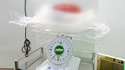 Phẫu thuật thành công u xơ tử cung khổng lồ gần 12 kg