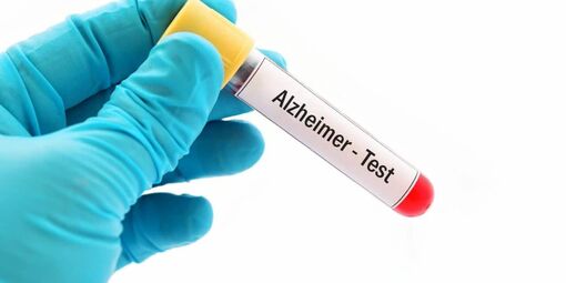 Bộ xét nghiệm máu mới giúp phát hiện sớm bệnh Alzheimer