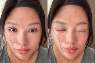 Sáu năm không nhắm được mắt khi ngủ sau khi cắt mí tại cơ sở 'chui'