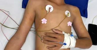 Cứu sống bệnh nhi Cà Mau bị ong vò vẽ đốt hơn 50 vết