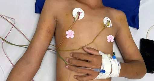 Cứu sống bệnh nhi Cà Mau bị ong vò vẽ đốt hơn 50 vết