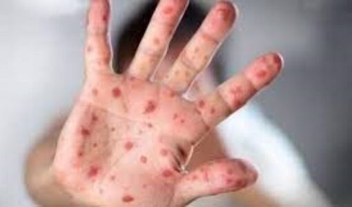 Anh ghi nhận ca tử vong đầu tiên ở người lớn do mắc sởi