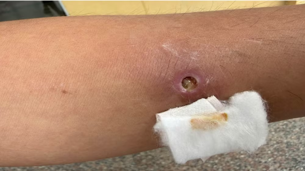 Thêm một ca giun rồng được phát hiện tại Việt Nam