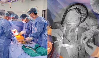 Lần đầu tiên tại Việt Nam cấy ghép thành công thiết bị hỗ trợ tim CorHeart 6