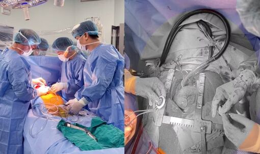 Lần đầu tiên tại Việt Nam cấy ghép thành công thiết bị hỗ trợ tim CorHeart 6