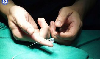 Lần đầu tiên tại Việt Nam: Đặt bóng vào khí quản thai nhi 30 tuần tuổi, cứu trẻ từ trong bụng mẹ