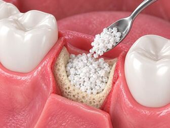 Mất răng lâu năm có trồng Implant được không?